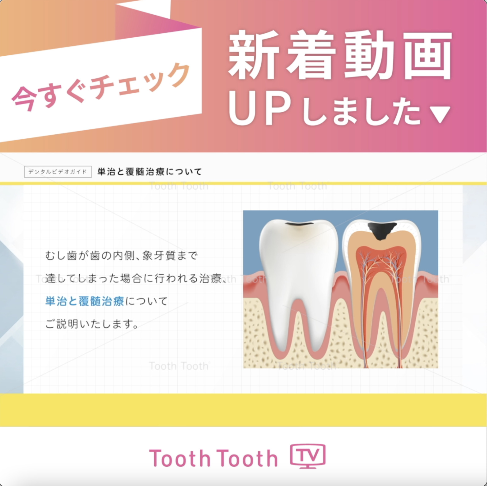 ToothToothTV 新着動画【デンタルビデオガイド 単治と覆髄治療について】